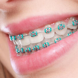 Braces