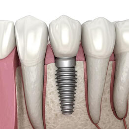 Implants