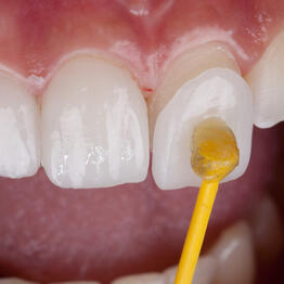 Veneers