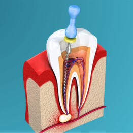 Root Canal